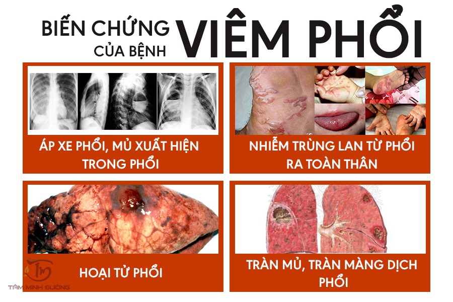 Tổng quan về nguyên nhân triệu chứng bệnh viêm phổi và cách điều trị