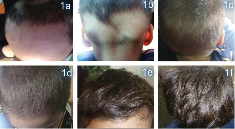 Hình ảnh Trước (1a, 1b) và Sau 12 tuần (1c, 1d), sau 12 tháng (1e, 1f) sử dụng sản phẩm Dr Michaels.