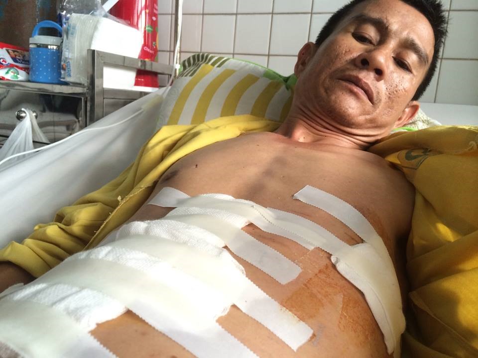 Vét thương bị tràn máu, tràn khí màng phổi và thủng tạng rỗng (thủng cơ hoành trái và thủng dạ dày mặt trước khoảng 2cm) do bị một vật nhọn đâm