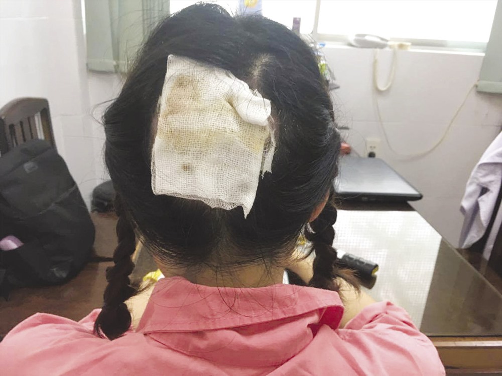Nữ bác sĩ 26 tuổi bị “bay” nguyên mảng da đầu lớn sau khi đi uốn tóc setting. Ảnh: V.Q