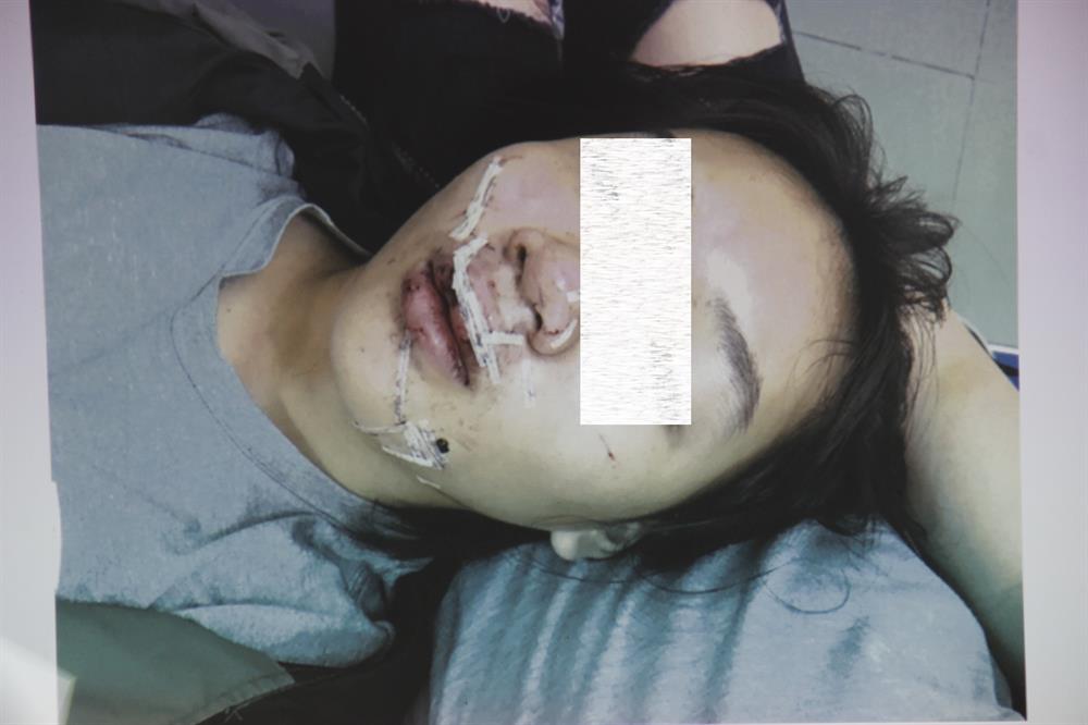 Gương mặt bé gái được bác sĩ khâu lại (ảnh N.Đ)