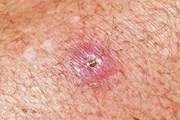 Dịch bệnh “ăn thịt người” Buruli bí ẩn lan rộng ở Úc Dịch bệnh “ăn thịt người” Buruli bí ẩn lan rộng ở Úc