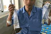 Cứu sống kịp thời nam bệnh nhân bị u đầu tụy hành hạ Cứu sống kịp thời nam bệnh nhân bị u đầu tụy hành hạ