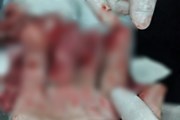Hơn 9 giờ đưa 3 ngón tay đứt lìa vào bệnh viện để khâu nối nhưng không thành Hơn 9 giờ đưa 3 ngón tay đứt lìa vào bệnh viện để khâu nối nhưng không thành