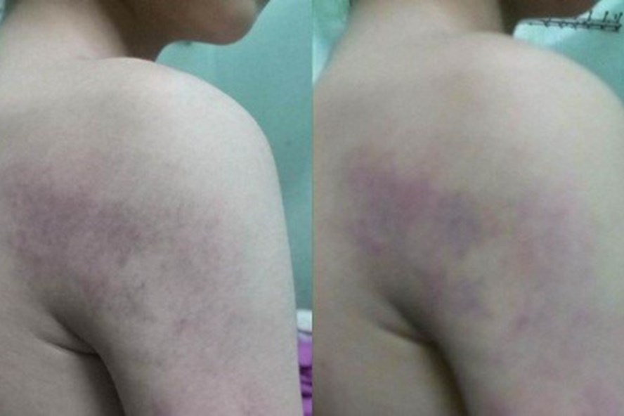 Há»c sinh lá»p 1 bá» cô giáo Äánh bầm tÃm ngưá»i.