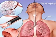 Bệnh viện Bạch Mai lấy làm tiếc về ca tử vong khi nội soi phế quản Bệnh viện Bạch Mai lấy làm tiếc về ca tử vong khi nội soi phế quản