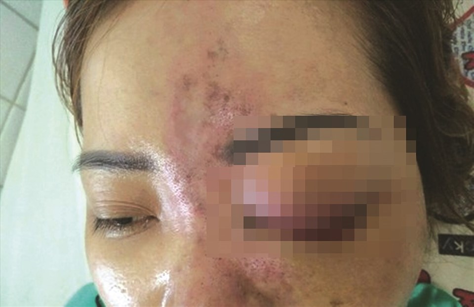 Mắt trái bệnh nhân sưng húp vì bơm chất làm đầy. Mắt trái bệnh nhân sưng húp vì bơm chất làm đầy.
