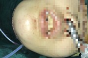 Bác sĩ đẽo gọt xương, ghép lại khuôn mặt cho bệnh nhân thế nào? Bác sĩ đẽo gọt xương, ghép lại khuôn mặt cho bệnh nhân thế nào?