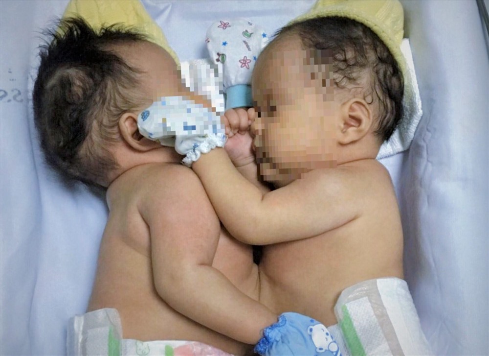 Hai bé sơ sinh dính liền nhau phần bụng