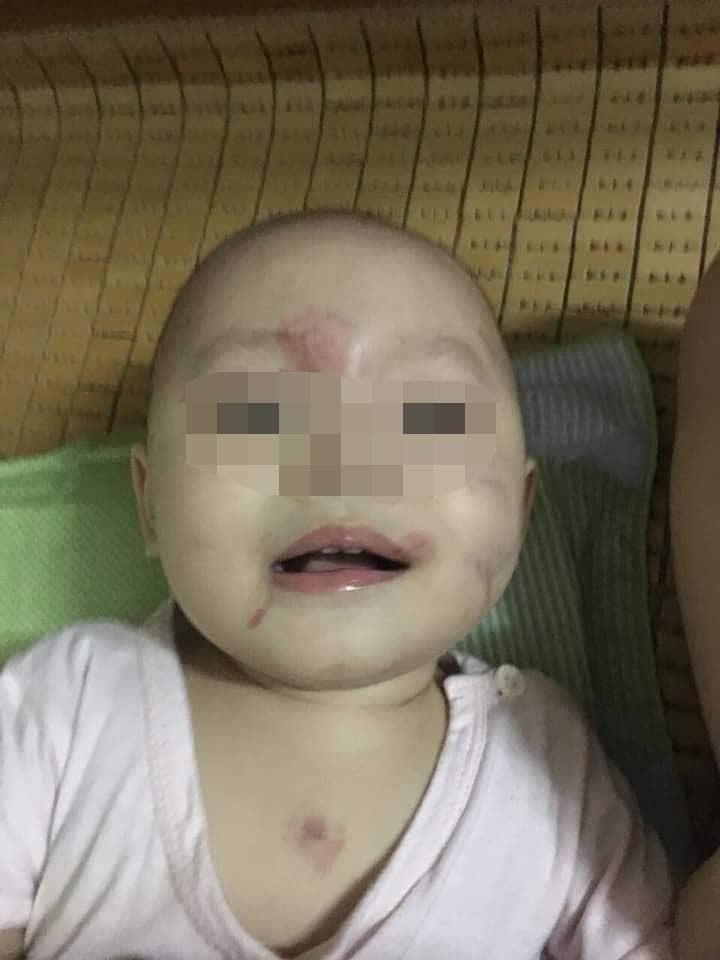Cháu Đ. mặt bầm tím sau ngày đầu tiên đến lớp.