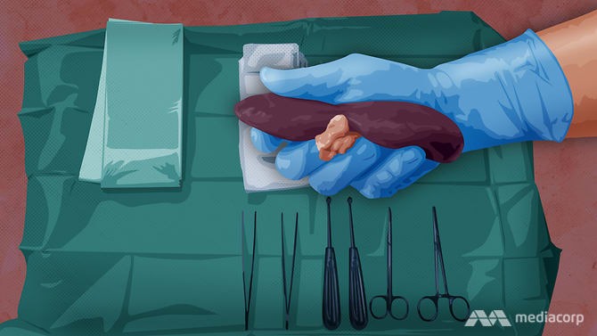 Buôn bán thận trái phép là một thị trường ngầm béo bở đã biến Philippines thành một điểm nóng buôn bán nội tạng của thế giới. Đồ họa của Channel News Asia.