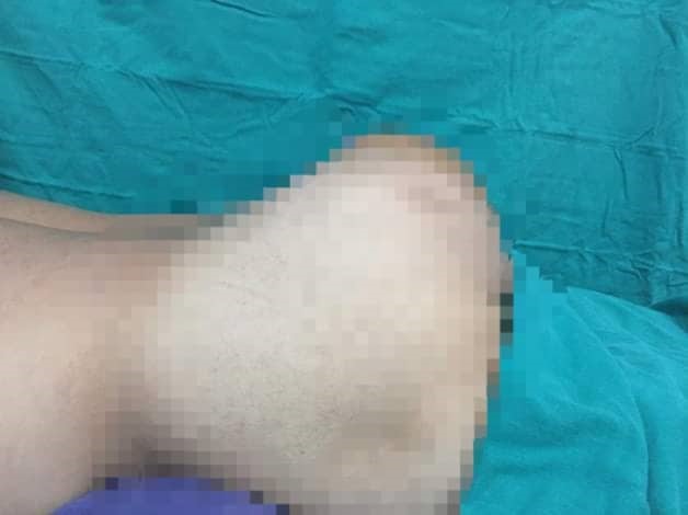 Hình ảnh khối u trước phẫu thuật. Ảnh: BSCC