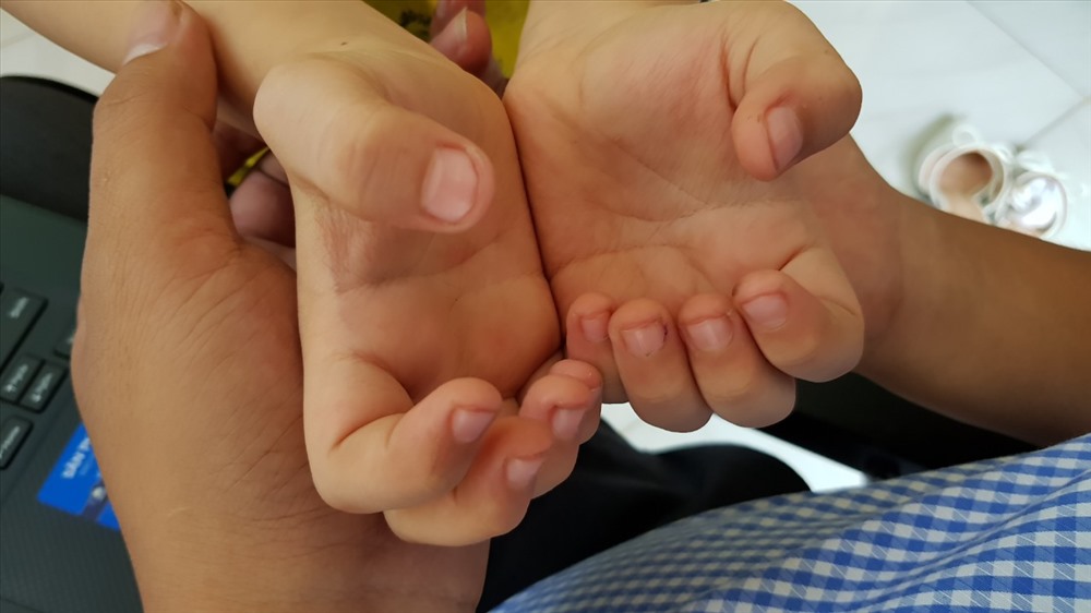 Tay cháu B bị cắt móng cụt rướm máu khiến gia đình không đồng ý. Ảnh: AX