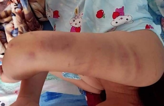 Một cánh tay khác bị bầm tím hết. Ảnh: AX