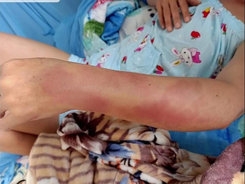 Cách tay chị K tấy đỏ, sưng phù sau khi bị chồng đánh. Ảnh: AX