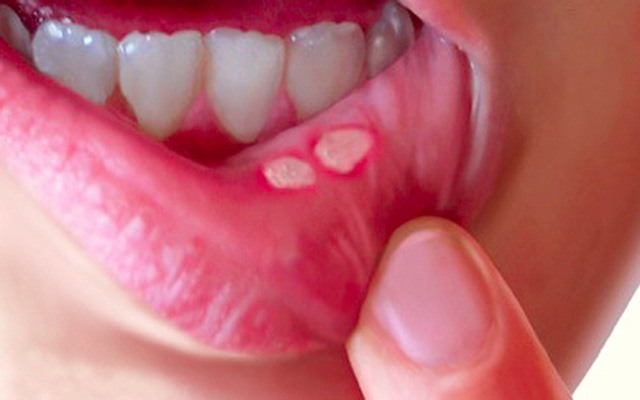 Nhiệt miệng là do thiếu vitamin C rất nhiều