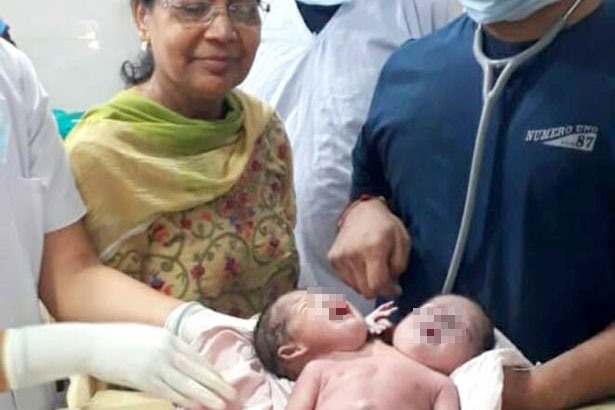Người mẹ đã sốc khi nhìn thấy đứa con đầu lòng bị dính liền. Ảnh: Caters News Agency