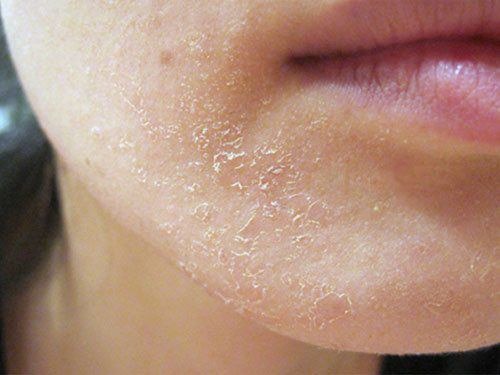 Hãy bổ sung Vitamin cho da để có một làn da khỏe mạnh.