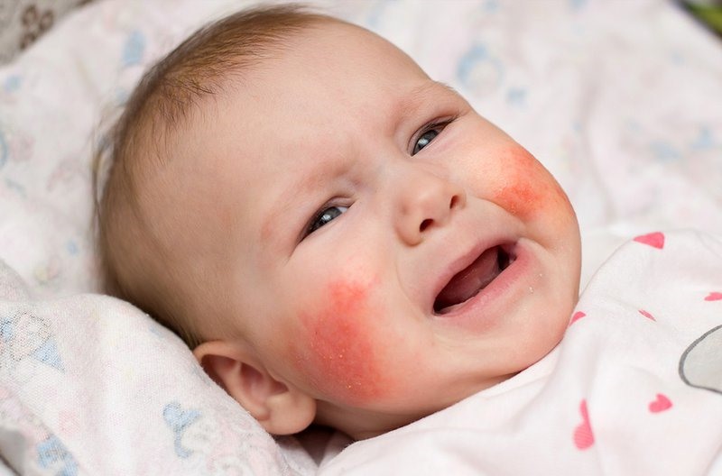 Tránh những điều kiện gây ra dị ứng không đáng có cho trẻ nhỏ.