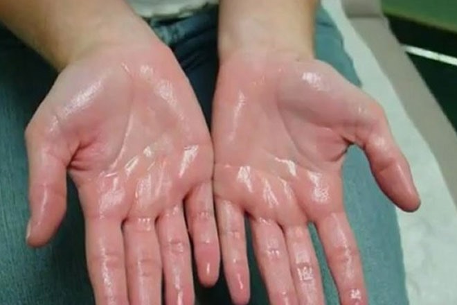 Lá lốt có thể điều trị được triệu chứng ra mồ hôi tay.