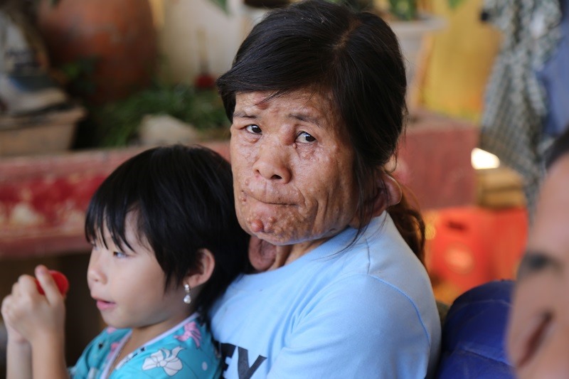 Chị Ngoan, con gái đầu ông Tê, cũng bị bệnh. Ảnh: LX