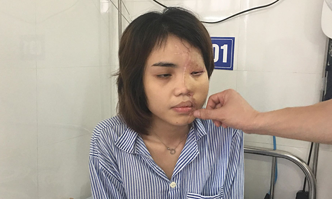 Gương mặt của Lan Vy hồi phục dần sau nhiều ca ghép. Ảnh: Lê Nga.