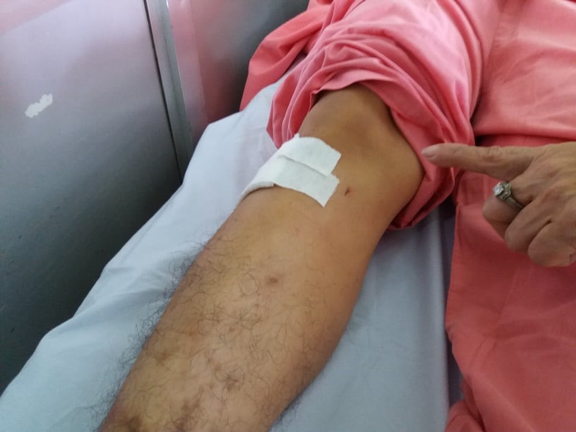 Vị trị bệnh nhân bị khoan xuyên đinh chân nhầm