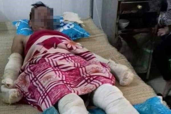 Một trong những nạn nhân đang được điều trị tại bệnh viện. Ảnh: Người dân cung cấp
