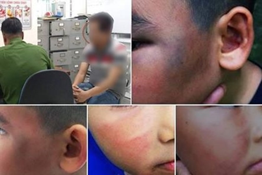 Bé C bị hành hung với nhiều thương tích và ông T làm việc với công an. Ảnh: NVCC