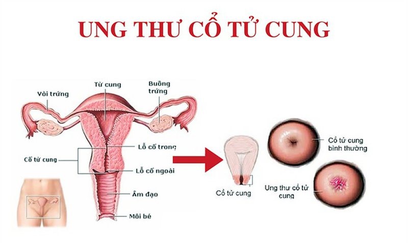Ung thư cổ tử cung là ung thư
