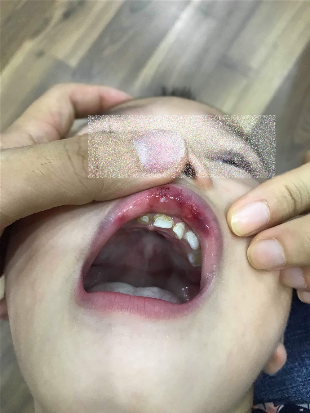 Môi và miệng của bé cũng bị sưng tấy.