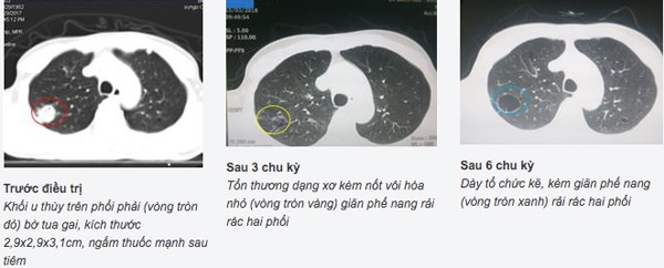 Sau 6 chu kỳ, bệnh nhân đáp ứng rất tốt.