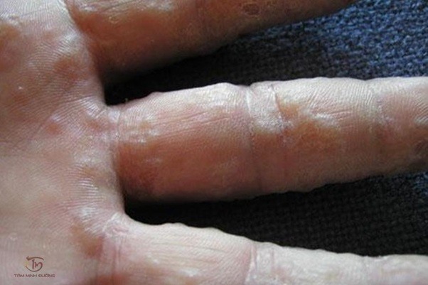 Hình ảnh tổ đỉa ở bệnh nhân