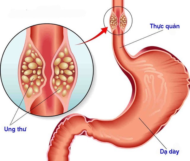 Nếu không chữa trị dứt điểm, biến chứng nguy hiểm nhất của bệnh là tiền ung thư và ung thư. Ảnh minh họa.