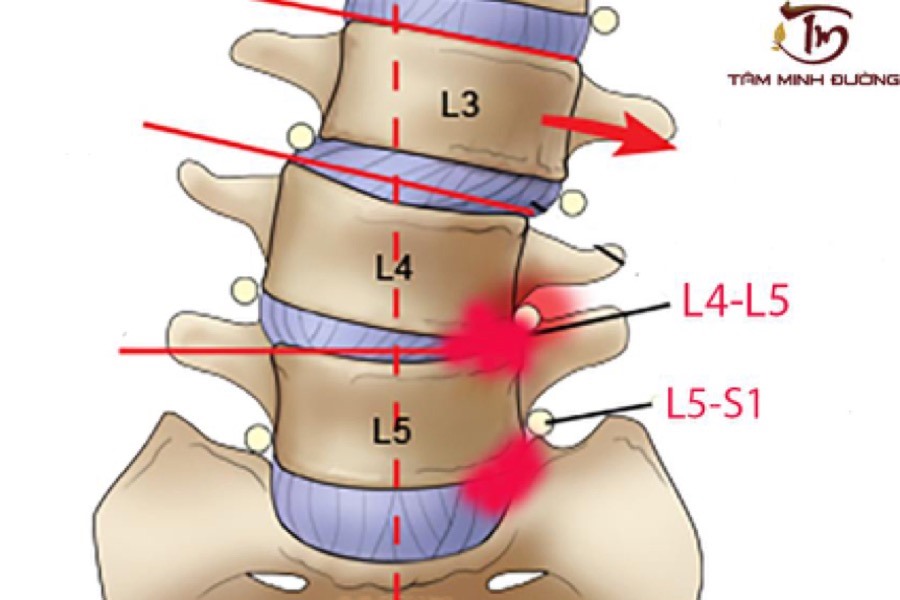 Thoát vị đĩa đệm l4 l5, l5 s1 là bệnh lý gây “ám ảnh” với nhiều người