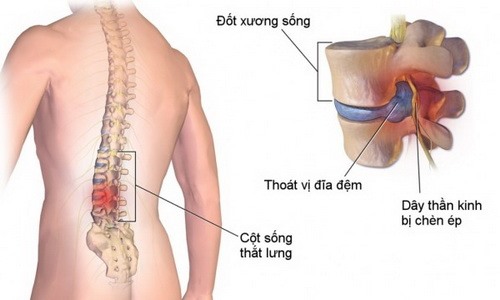 Hình ảnh thoát vị đĩa đệm. Ảnh: freeyourspine.info.