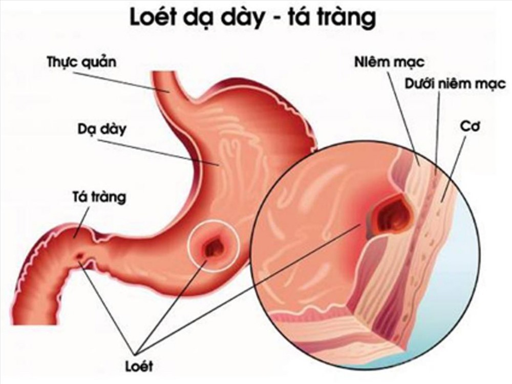 Hình ảnh viêm loét dạ dày. Ảnh: vinmec.com.