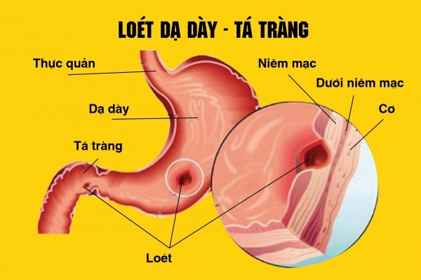 Hình ảnh đau dạ dày. Ảnh: chuabenhtieuhoa.net.