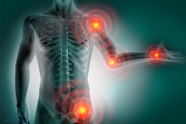 Thấp khớp là căn bệnh phổ biến có tính cộng đồng và biến chứng nguy hiểm cao