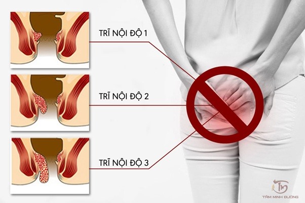 Bệnh trĩ nội độ 1, 2, 3 có nguy hiểm không, điều trị bằng cách nào?