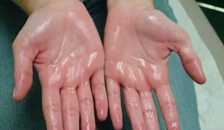 Trường hợp nặng, mồ hôi ra như nước chảy. Ảnh: thuocdantoc.org.