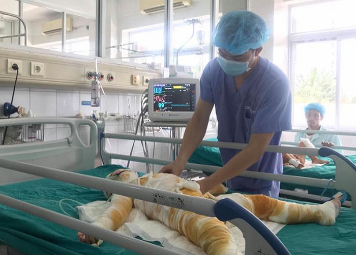 Tình trạng sức khỏe của 3 trẻ bị bỏng vẫn rất xấu, đang được điều trị tại bệnh viện. Ảnh: ĐV.