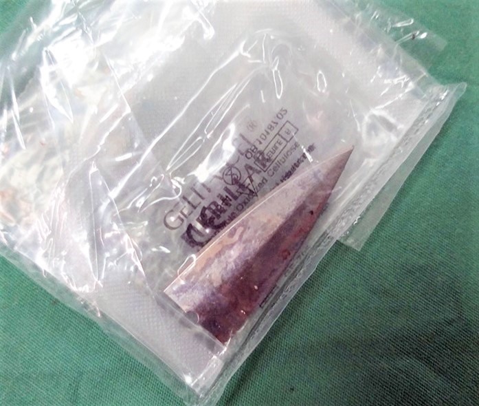 Mũi dao lấy ra từ cơ thể anh N.V.T. Ảnh: BVCC