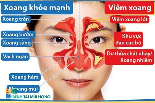 Bệnh việm xong có thể gây ra nhiều biến chứng nguy hiểm. Ảnh: benhtaimuihong.net.