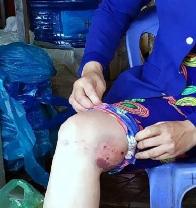 Vết chó cắn trên đùi của chị N., người đi chợ phường 7, Thành phố Cà Mau bị chó dại cắn (ảnh Nhật Hồ)