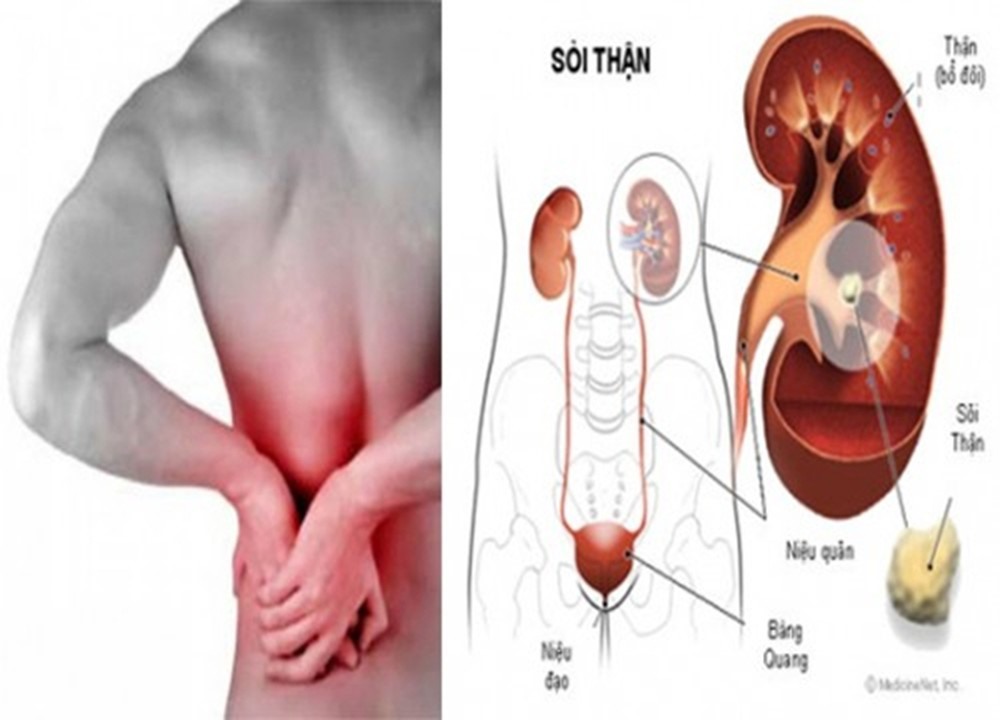 Nguyên nhân gây sỏi tiết niệu là do trong nước tiểu có chứa quá nhiều các chất oxalat, canxi, axit uric... không thể hòa tan, tạo thành sỏi. ảnh: T.H