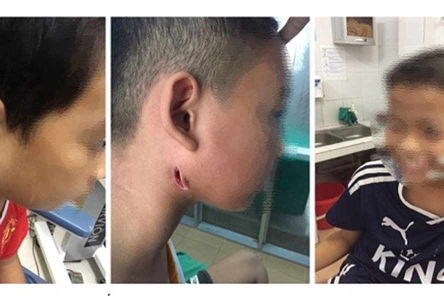 Bệnh viện Sản Nhi tỉnh Nghệ An cho biết, thời gian vừa qua, tại đây đã phát hiện 3 bệnh nhân nhi có vi khuẩn “ăn thịt người“.