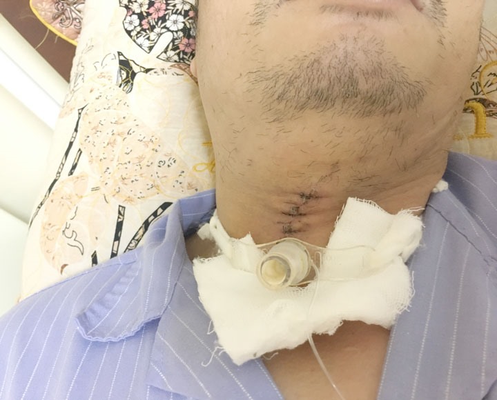 Hình ảnh người bệnh sau phẫu thuật được hỗ trợ thở qua Cannuyn