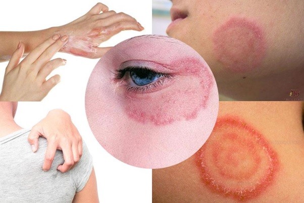 Hình ảnh hắc lào ở bệnh nhân (Ảnh minh họa)