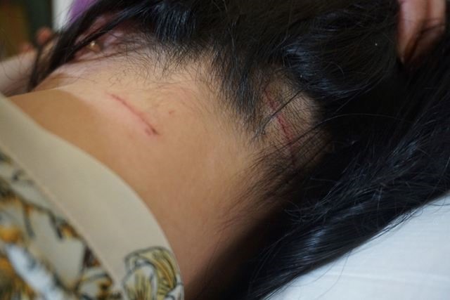Những vết thương trên đầu, trên cổ chị Trang mà Thắng dùng kéo gây ra. Ảnh: Trần Tuấn